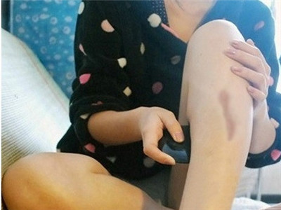 武漢激光去疤痕的方法一般要多少錢(qián)？