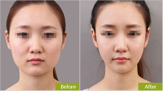 天津面部做吸脂一次多少錢？