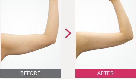 武漢手臂吸脂減肥多少錢？