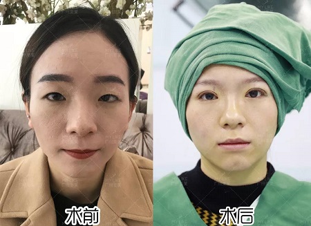 好看的雙眼皮對(duì)顏值真是救命的效果!!!