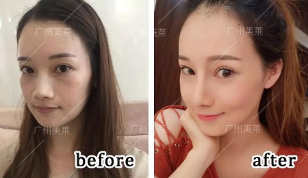 3年隆鼻案例回顧！