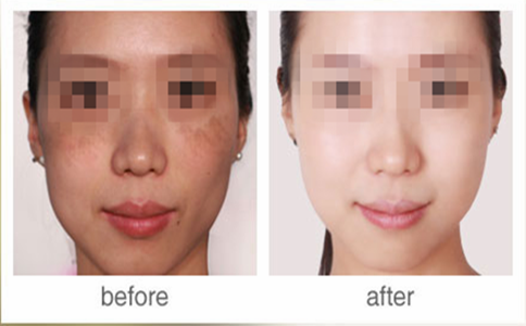 重慶做激光祛斑一次大概多少錢？