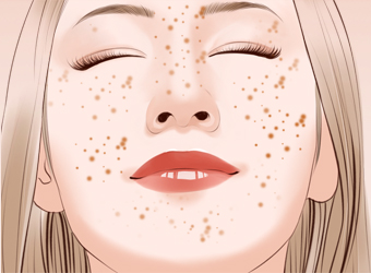 南京激光去雀斑的價(jià)格是多少？