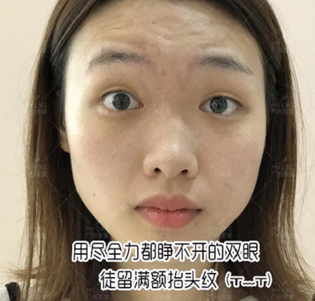 <a href='/ybzx/syp/' target='_blank'><u>割雙眼皮</u></a>10天后，男朋友都夸她美炸天！