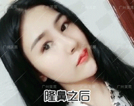 隆了個(gè)鼻，臉竟瘦了1圈？