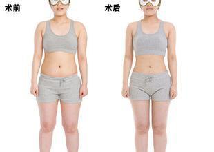 天津全身吸脂手術價格是多少錢？