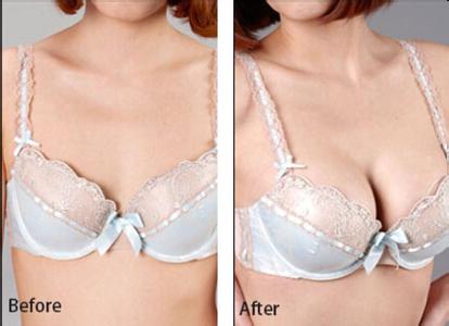 廣州假體豐胸多少錢？