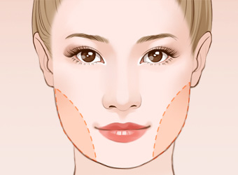 武漢面部吸脂怎么樣？