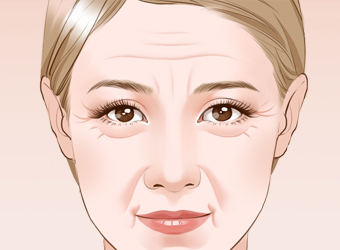 天津自體脂肪注射除皺價格？