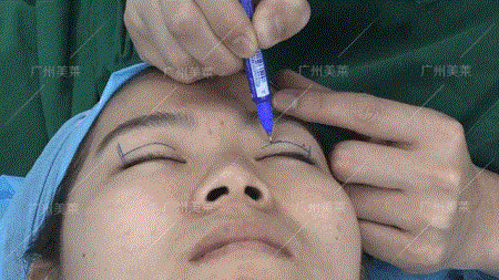 這6種眼睛，割了5天就有換頭般效果！