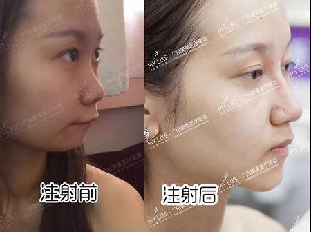 5個(gè)案例告訴你，玻尿酸即刻效果多明顯？！