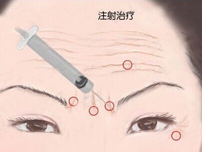 寧波注射除皺有哪些優(yōu)勢(shì)？