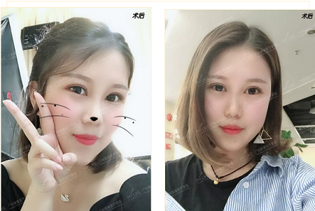 雙眼皮貼10年，割1刀，美20倍！