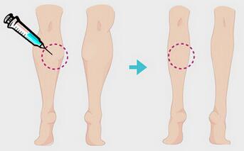 昆明瘦腿多少錢？