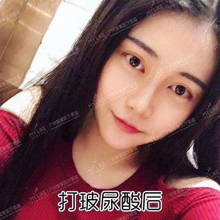 玻尿酸打這3個部位，立即換張臉！