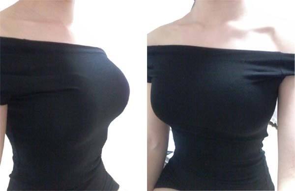 假體隆胸前后有什么區(qū)別？
