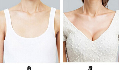 做隆胸大概費用多少？