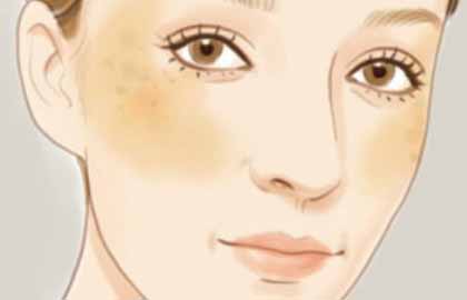 點斑需要多少錢？