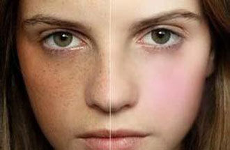 激光去雀斑多少錢？