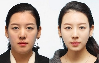 改臉型需要多少錢？