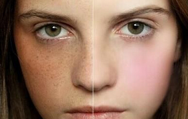 激光祛斑需要多久？