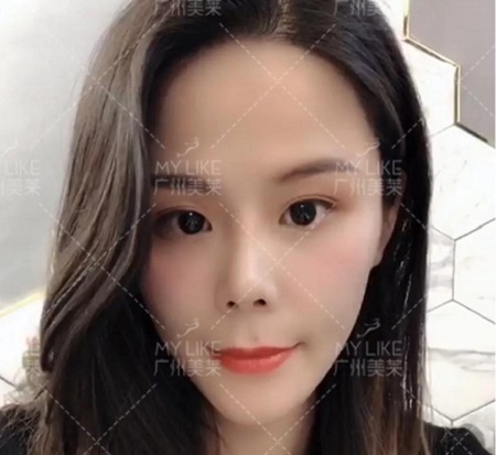 速美打造神奇——玻尿酸，讓你蛻變！