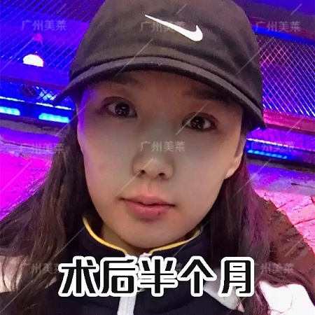 下垂眼割無辜桃花眼后，美成咋樣了？