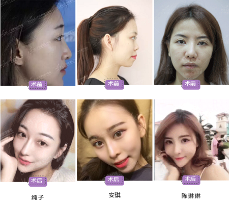 看完這些，你能避開所有隆鼻誤區(qū)！