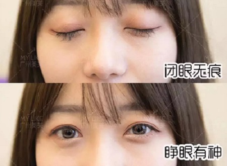 陰森小眼<a href='/ybzx/syp/' target='_blank'><u>割雙眼皮</u></a>后7天，竟如小鹿般精靈可愛？