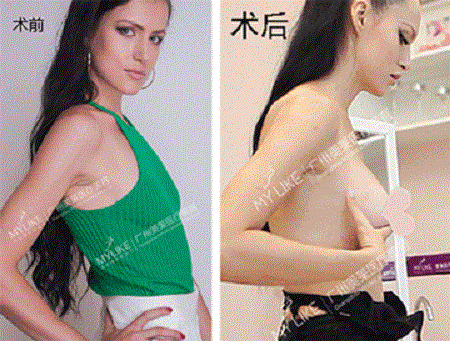 3月21日，國(guó)際乳房整容醫(yī)師穆大力來(lái)了！親診名額限量預(yù)約！