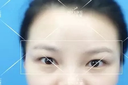 腫眼泡不僅難看還更容易衰老！