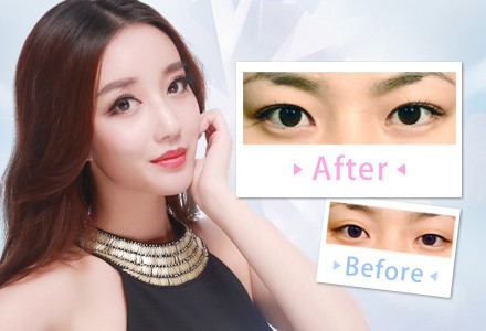 做個(gè)雙眼皮的價(jià)格要多少錢？
