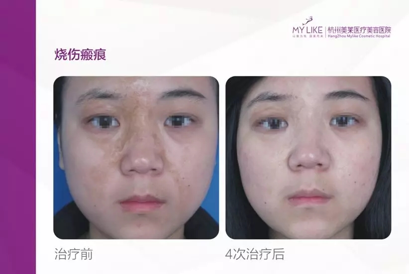 免費皮膚疤痕修復(fù)