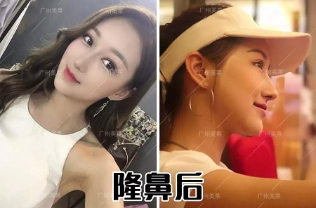 隆鼻3天后，從素人撞臉關(guān)曉彤？