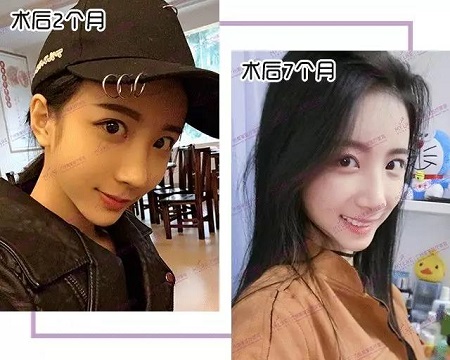 鼻修復(fù)7個月后，朝天鼻蛻變驚艷，側(cè)顏美炸天！