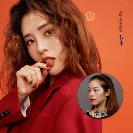 玻尿酸停打有危害嗎？打多了會(huì)怎樣？