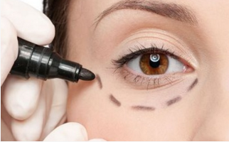 去眼袋內(nèi)切需要多久恢復？