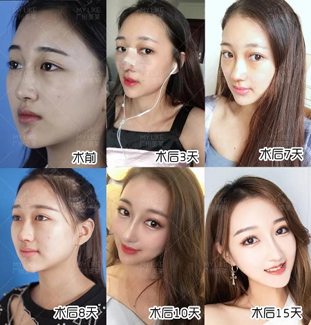 隆鼻后7天拆線，10天上妝美炸天！