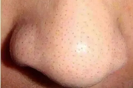 你知道臉上的黑頭和白頭是怎么形成的嗎？