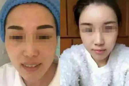 自體脂肪活顏精*，讓你年輕20歲