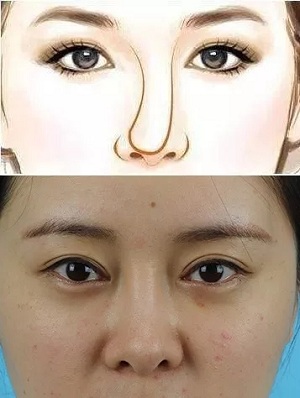 “鼻綜合”后假又歪，還攣縮？鼻修復還原自然生態(tài)美鼻