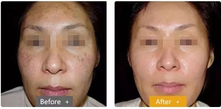 祛斑偏方“害死人”，小仙女們可長(zhǎng)點(diǎn)心吧！