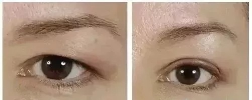 推薦這幾種增大眼睛的方法，除了開外眼角！