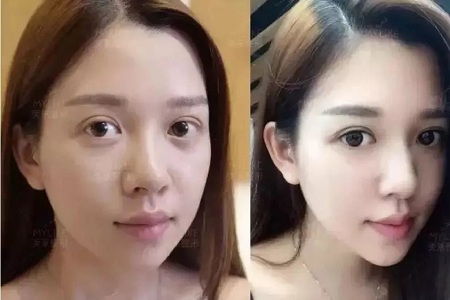 推薦這幾種增大眼睛的方法，除了開外眼角！