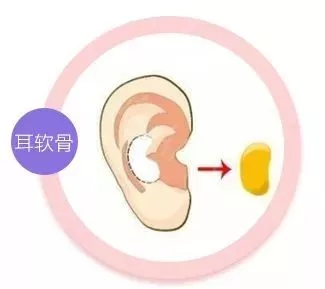 擔心鼻整形假體透光、發(fā)紅、移位？了解下自體軟骨