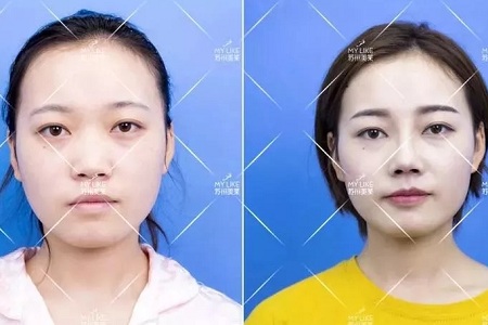 擔心鼻整形假體透光、發(fā)紅、移位？了解下自體軟骨