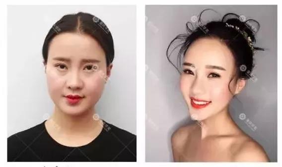 能瘦臉，又能除皺的瘦臉針，了解一下！