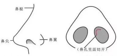 隆鼻手術(shù)切口在哪里？才能自然不留疤