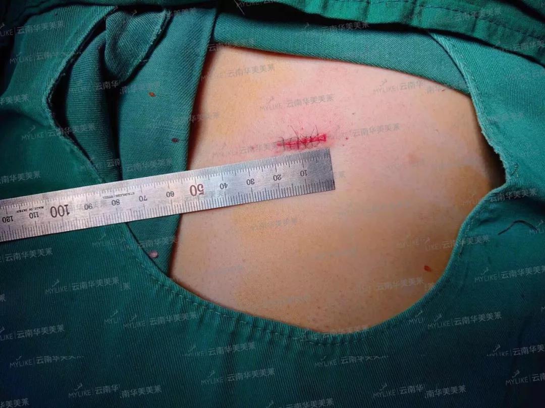 美萊綜合塑鼻升級了，價格還卻更低了！