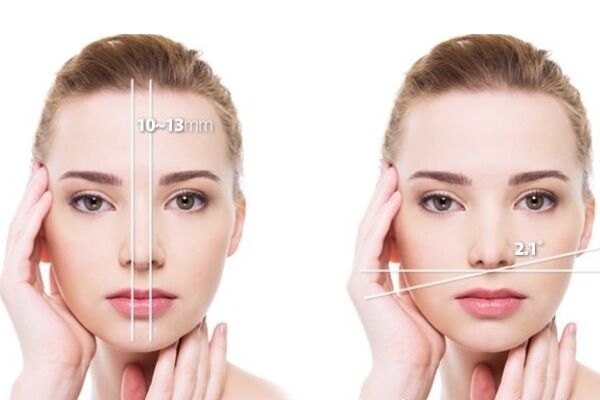 整鼻子要花多少錢？